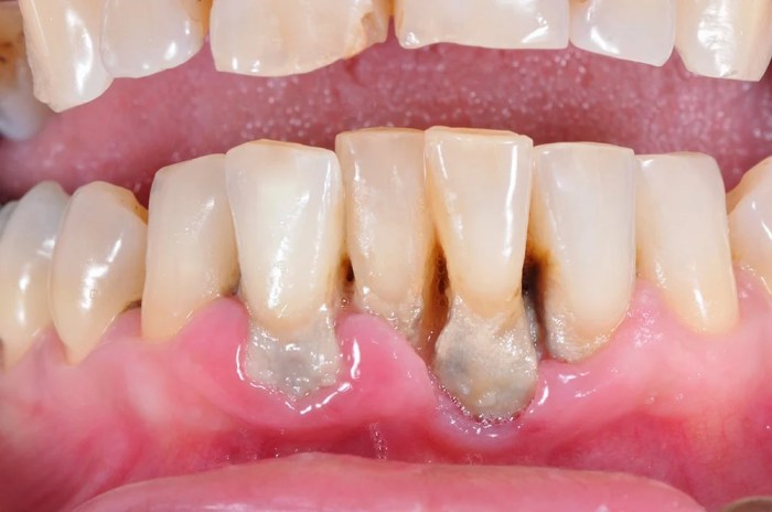 Gum disease as it worsens progresses from to