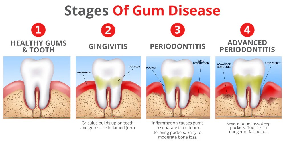 Gum disease as it worsens progresses from to